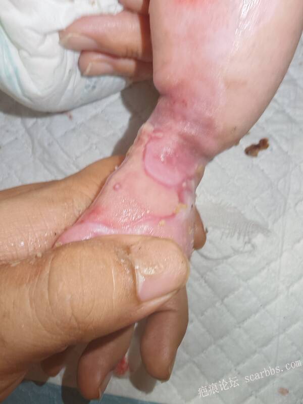 李高令老了，确真的很苦恼！走路腿还疼…今天却必须要岀一次远门。（北京新生儿皮缺… 