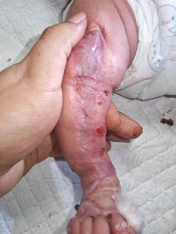 李高令老了，确真的很苦恼！走路腿还疼…今天却必须要岀一次远门。（北京新生儿皮缺… 