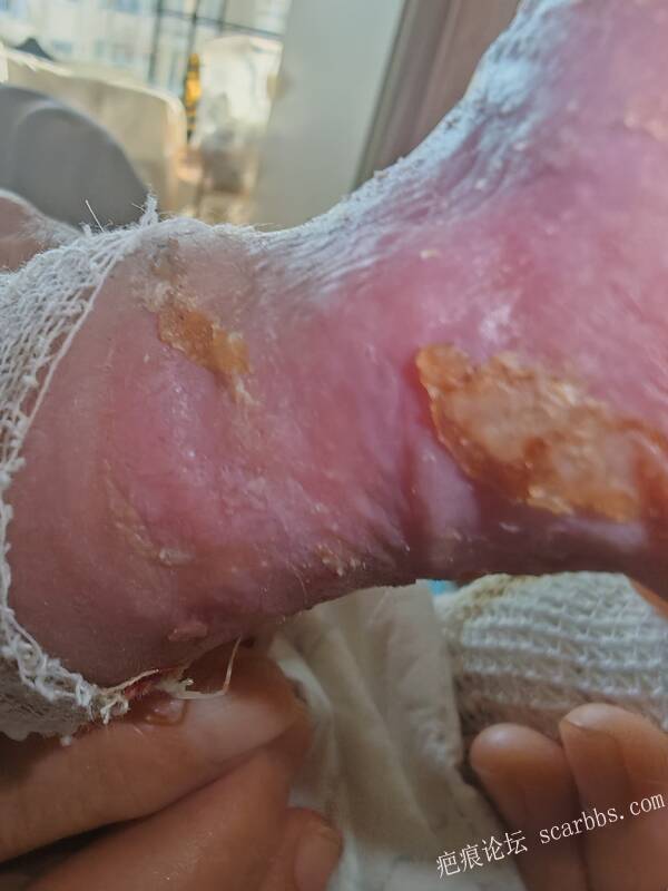 老了，确真的很苦恼！走路腿还疼…今天却必须要岀一次远门。（北京新生儿皮缺…） 