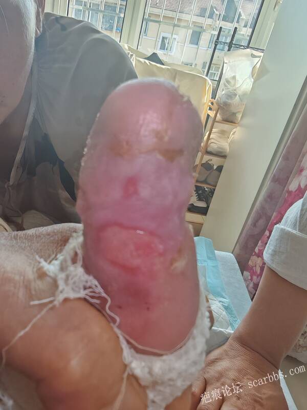 老了，确真的很苦恼！走路腿还疼…今天却必须要岀一次远门。（北京新生儿皮缺…） 