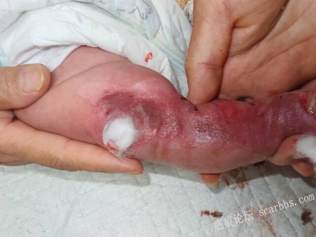 李高令老了，确真的很苦恼！走路腿还疼…今天却必须要岀一次远门。（北京新生儿皮缺… 