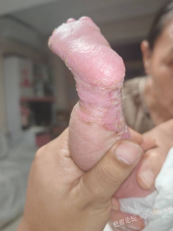 李高令老了，确真的很苦恼！走路腿还疼…今天却必须要岀一次远门。（北京新生儿皮缺… 
