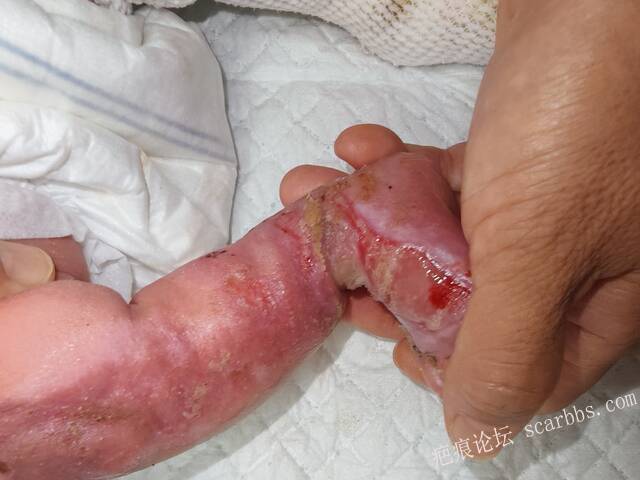 李高令老了，确真的很苦恼！走路腿还疼…今天却必须要岀一次远门。（北京新生儿皮缺… 