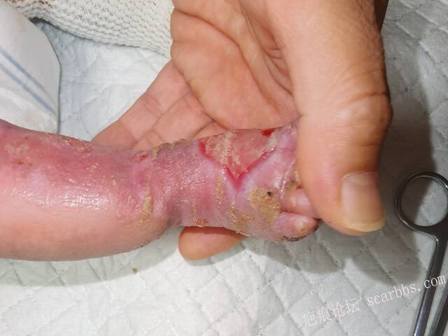 李高令老了，确真的很苦恼！走路腿还疼…今天却必须要岀一次远门。（北京新生儿皮缺… 