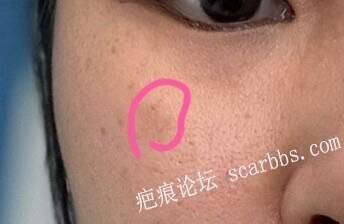 好几年的无表皮疤痕还能放药淡化吗