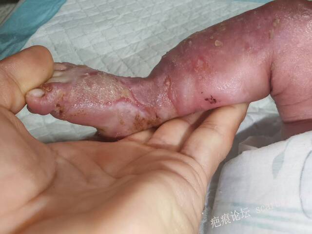 李高令老了，确真的很苦恼！走路腿还疼…今天却必须要岀一次远门。（北京新生儿皮缺… 