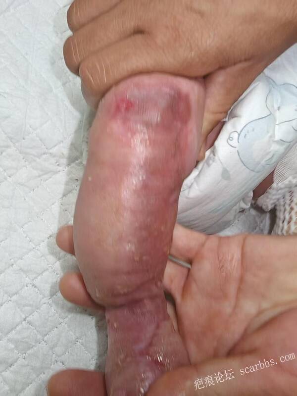 李高令老了，确真的很苦恼！走路腿还疼…今天却必须要岀一次远门。（北京新生儿皮缺… 