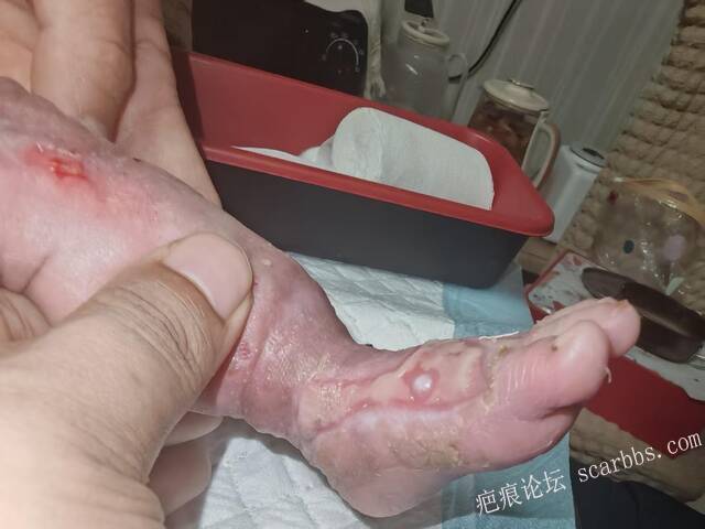 李高令老了，确真的很苦恼！走路腿还疼…今天却必须要岀一次远门。（北京新生儿皮缺… 