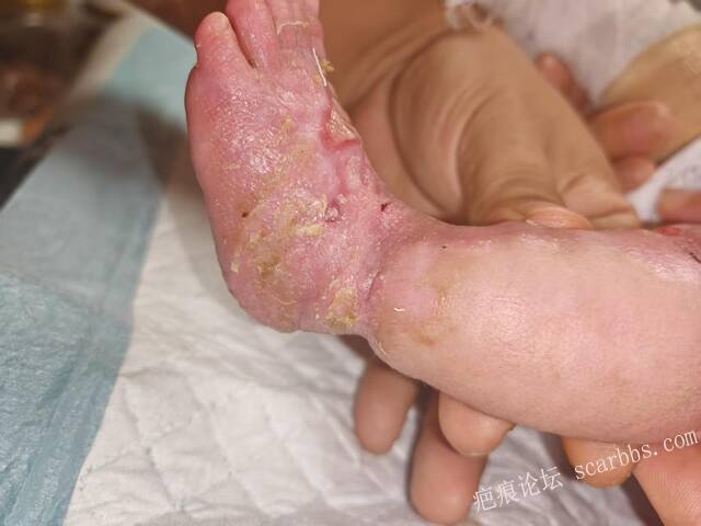 李高令老了，确真的很苦恼！走路腿还疼…今天却必须要岀一次远门。（北京新生儿皮缺… 