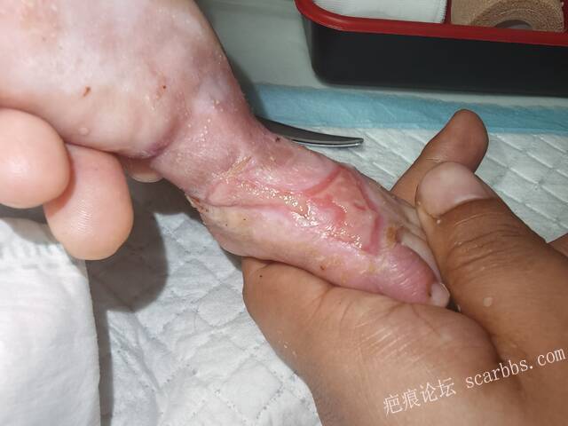 李高令老了，确真的很苦恼！走路腿还疼…今天却必须要岀一次远门。（北京新生儿皮缺… 