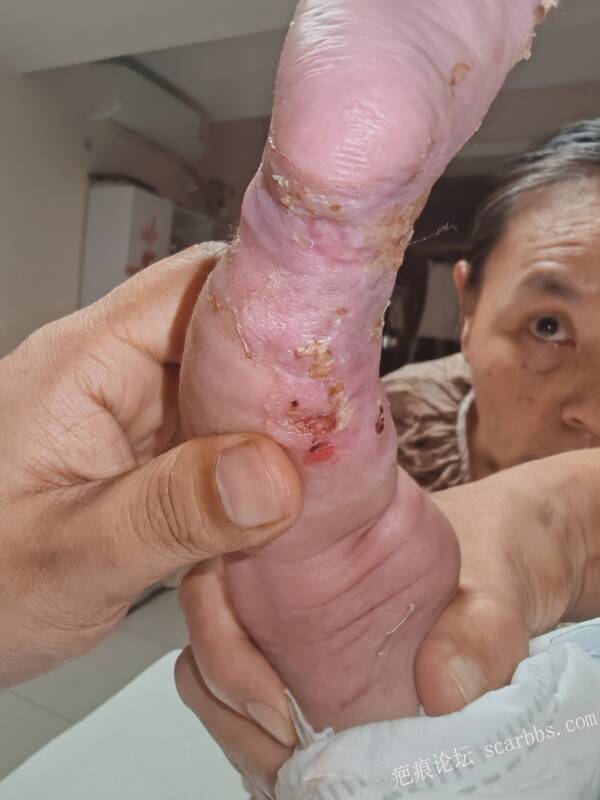 李高令老了，确真的很苦恼！走路腿还疼…今天却必须要岀一次远门。（北京新生儿皮缺… 