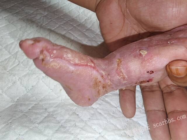 李高令老了，确真的很苦恼！走路腿还疼…今天却必须要岀一次远门。（北京新生儿皮缺… 
