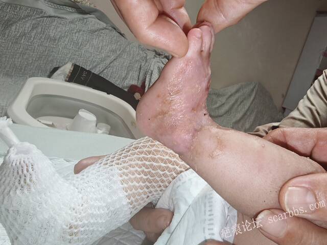 李高令老了，确真的很苦恼！走路腿还疼…今天却必须要岀一次远门。（北京新生儿皮缺… 