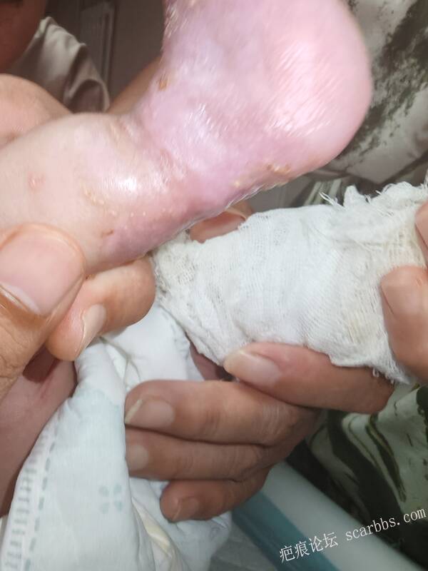李高令老了，确真的很苦恼！走路腿还疼…今天却必须要岀一次远门。（北京新生儿皮缺… 