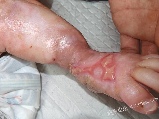 李高令老了，确真的很苦恼！走路腿还疼…今天却必须要岀一次远门。（北京新生儿皮缺… 
