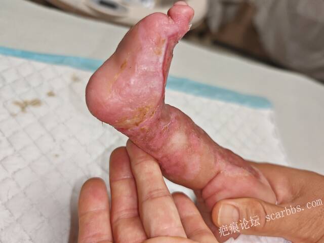 李高令老了，确真的很苦恼！走路腿还疼…今天却必须要岀一次远门。（北京新生儿皮缺… 