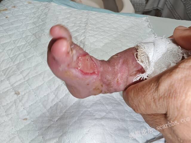 李高令老了，确真的很苦恼！走路腿还疼…今天却必须要岀一次远门。（北京新生儿皮缺… 
