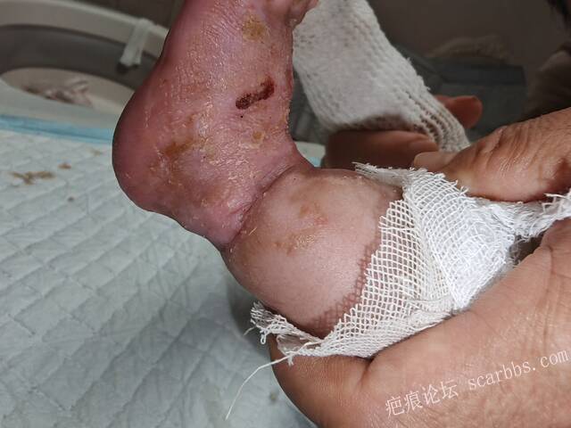 李高令老了，确真的很苦恼！走路腿还疼…今天却必须要岀一次远门。（北京新生儿皮缺… 