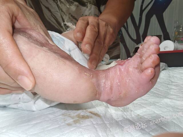 李高令老了，确真的很苦恼！走路腿还疼…今天却必须要岀一次远门。（北京新生儿皮缺… 