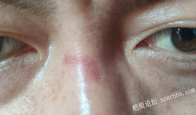 凹陷疤痕激光后需要涂生长因子吗