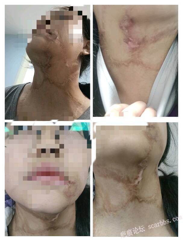 做完手术了，大家有什么护理技巧能教教我吗？
