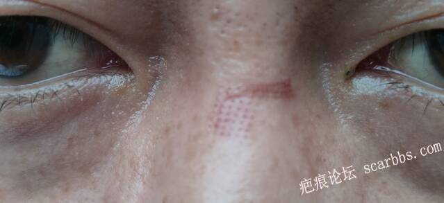 凹陷疤痕激光后需要涂生长因子吗 