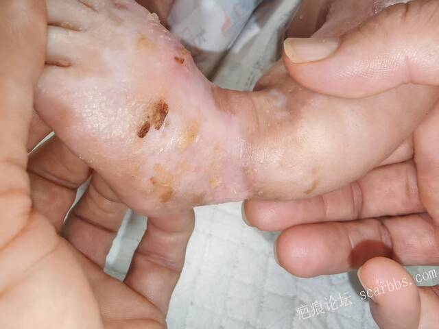 李高令老了，确真的很苦恼！走路腿还疼…今天却必须要岀一次远门。（北京新生儿皮缺… 