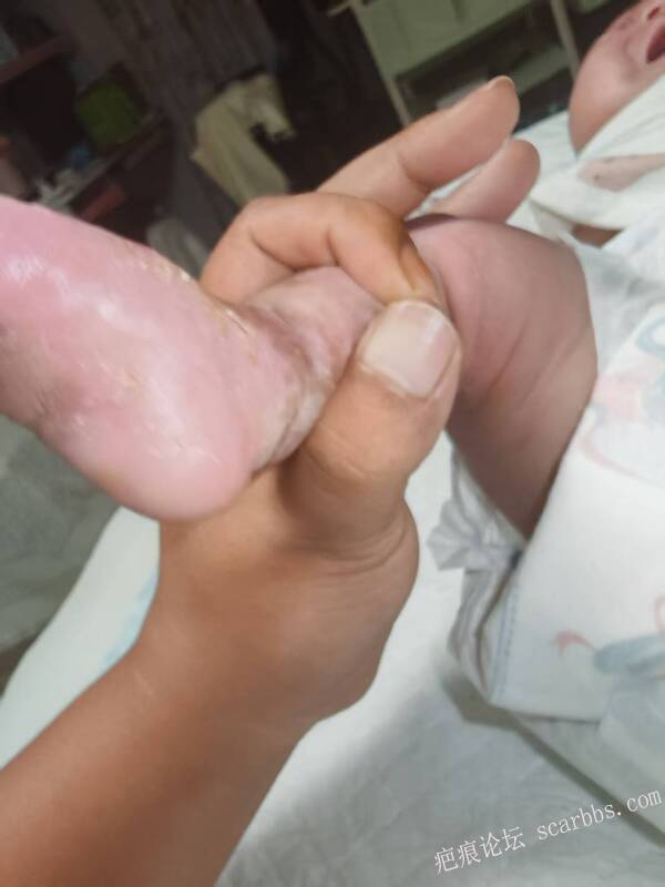 李高令老了，确真的很苦恼！走路腿还疼…今天却必须要岀一次远门。（北京新生儿皮缺… 