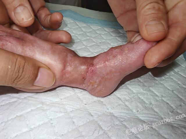 李高令老了，确真的很苦恼！走路腿还疼…今天却必须要岀一次远门。（北京新生儿皮缺… 