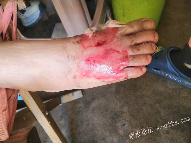 李高令2026年又接治一个被开水烫伤的孩子。 