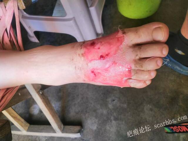 李高令2026年又接治一个被开水烫伤的孩子。 
