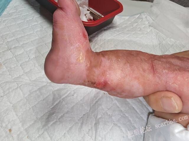李高令老了，确真的很苦恼！走路腿还疼…今天却必须要岀一次远门。（北京新生儿皮缺… 