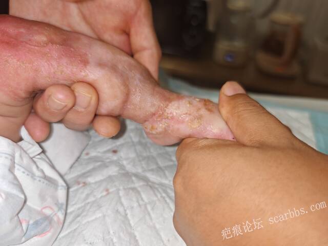 李高令老了，确真的很苦恼！走路腿还疼…今天却必须要岀一次远门。（北京新生儿皮缺… 