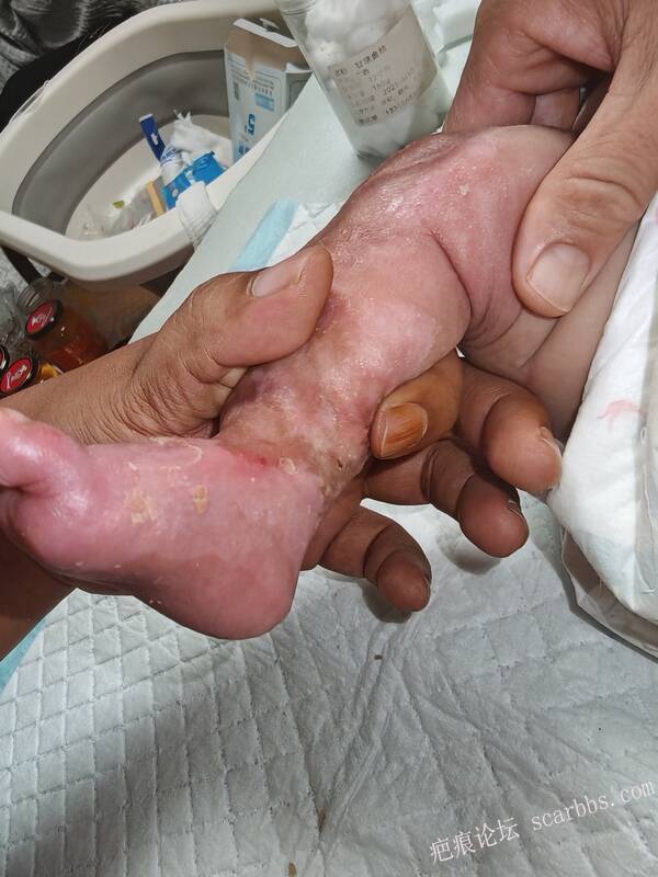 李高令老了，确真的很苦恼！走路腿还疼…今天却必须要岀一次远门。（北京新生儿皮缺… 