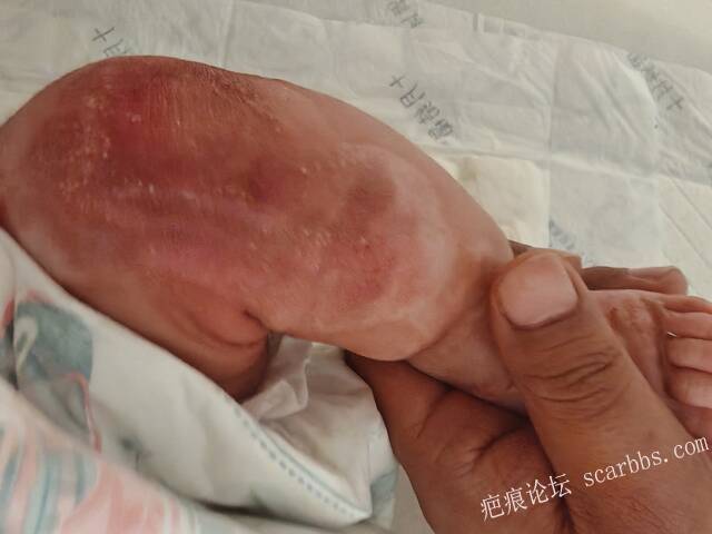 李高令老了，确真的很苦恼！走路腿还疼…今天却必须要岀一次远门。（北京新生儿皮缺… 