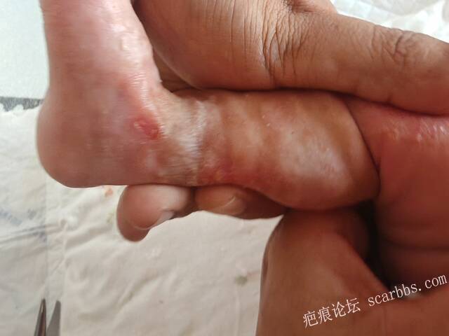 李高令老了，确真的很苦恼！走路腿还疼…今天却必须要岀一次远门。（北京新生儿皮缺… 