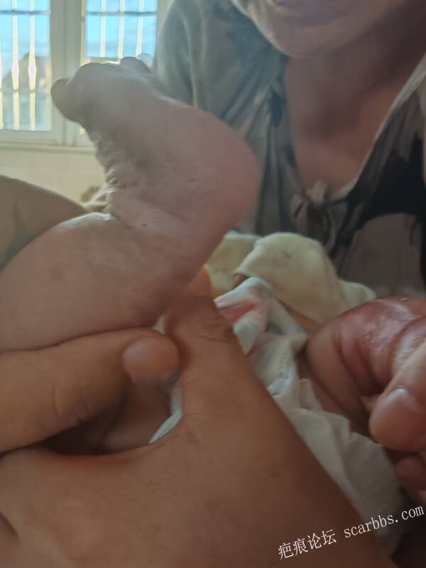 李高令老了，确真的很苦恼！走路腿还疼…今天却必须要岀一次远门。（北京新生儿皮缺… 