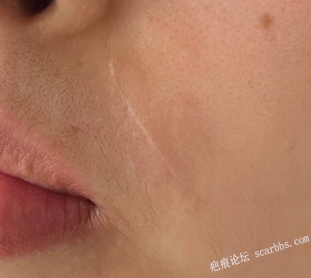 避雷，切缝四年了，还是一条白线