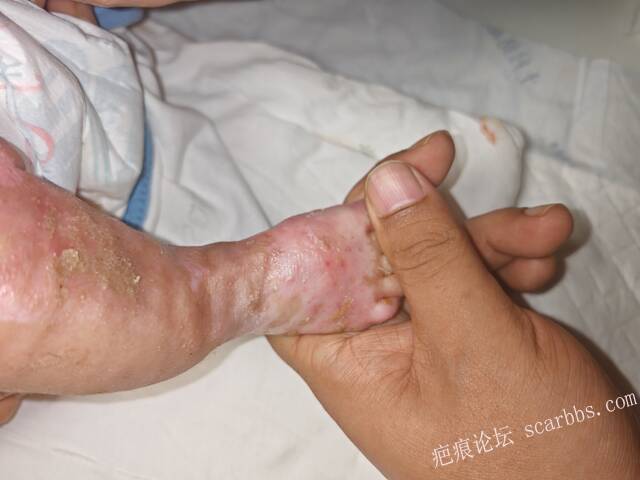 李高令老了，确真的很苦恼！走路腿还疼…今天却必须要岀一次远门。（北京新生儿皮缺… 