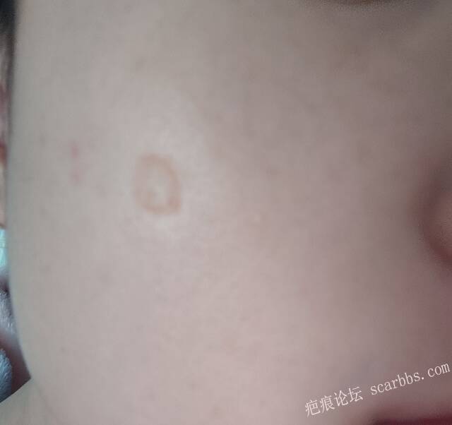 凹坑疤痕修复