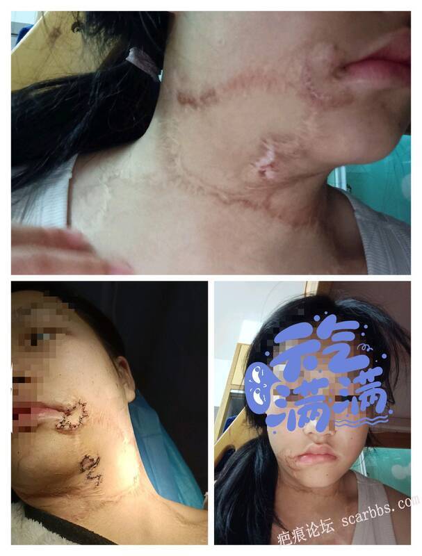 我想要做一个自己恢复过程的帖子 
