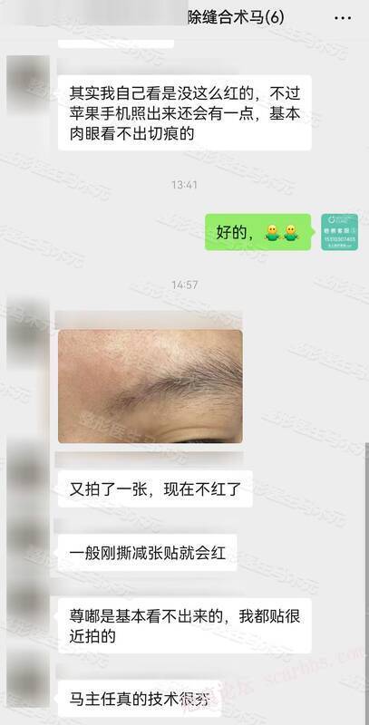 疤痕修复 