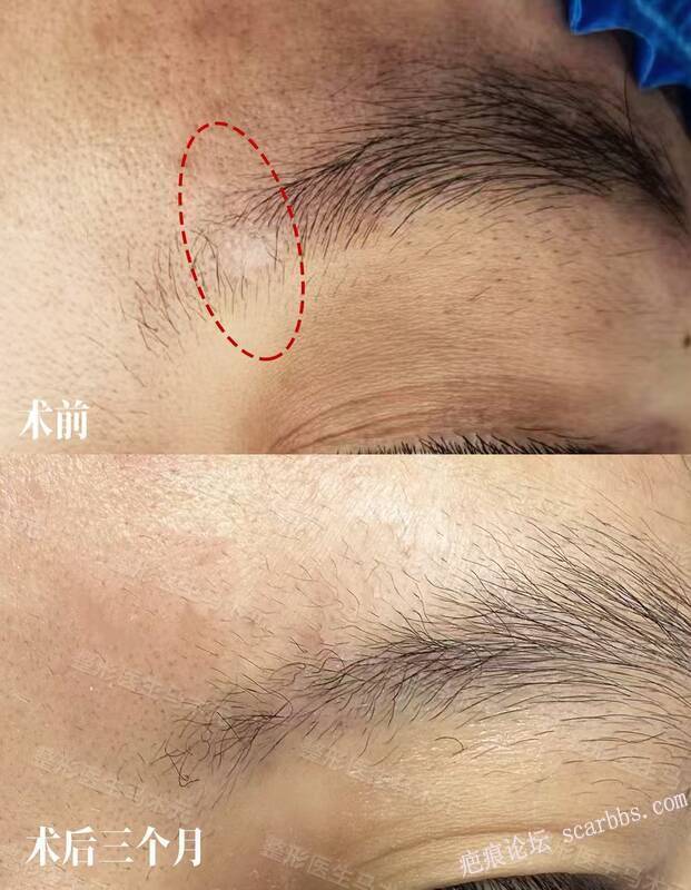 疤痕修复