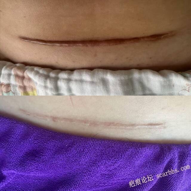那条剖腹产的疤，藏着多少妈妈的委屈与自卑