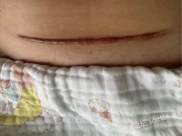 那条剖腹产的疤，藏着多少妈妈的委屈与自卑 