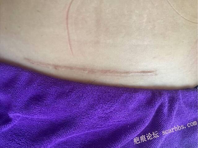 那条剖腹产的疤，藏着多少妈妈的委屈与自卑 