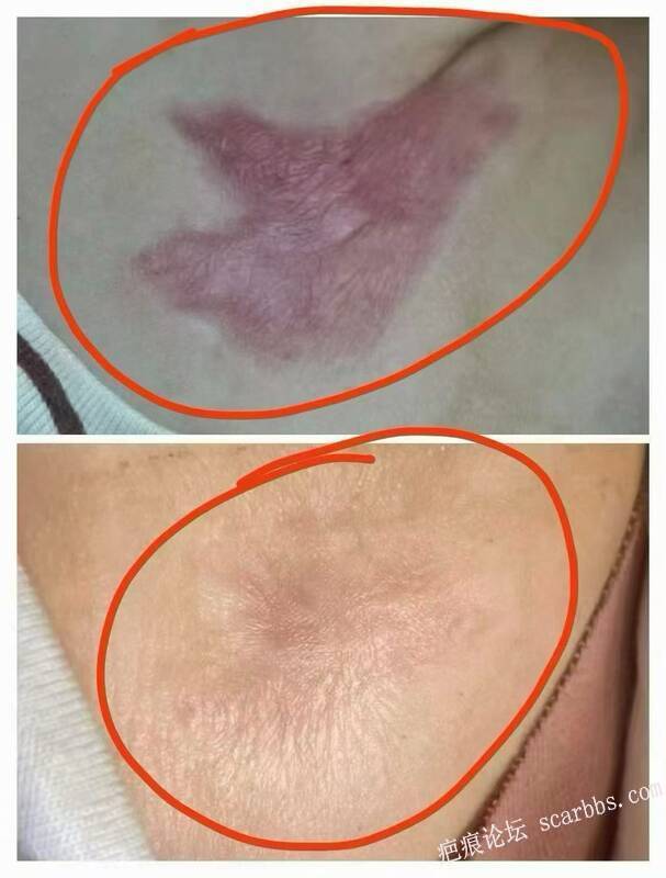 烧伤疤痕怎么治疗 