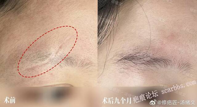 疤痕修复