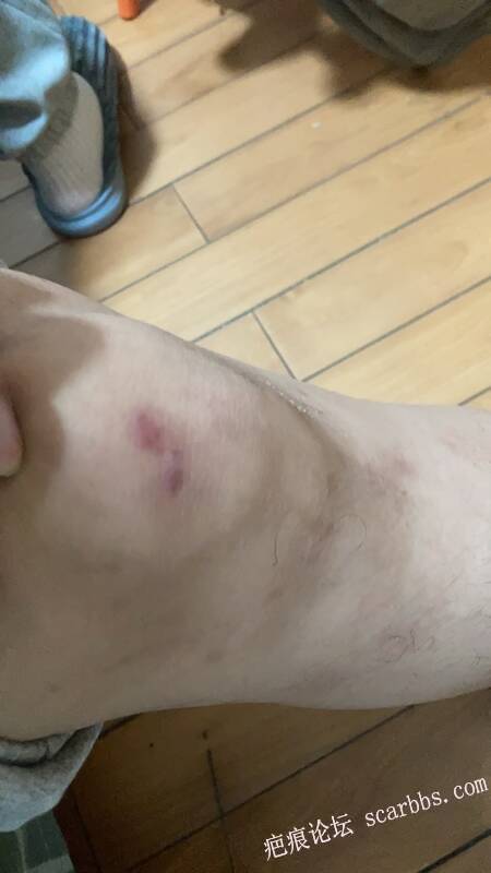 骑自行车摔倒留下的瘢痕组织 