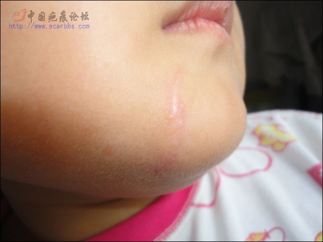 女儿面部玻璃划伤--记录 